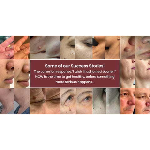 🌟XiMonth MICRONEEDLEBOTANIC SKIN TAG SOLUTION PATCH  InvisibleFace & Body Patches for RaisedMoles, Acne, Flat Warts & SkinTags -Helps Improve theAppearance of Wrinkles, Scars &Blemishes