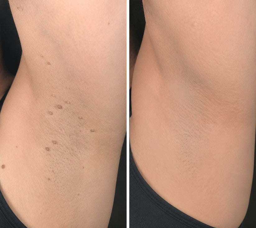 🌟XiMonth MICRONEEDLEBOTANIC SKIN TAG SOLUTION PATCH  InvisibleFace & Body Patches for RaisedMoles, Acne, Flat Warts & SkinTags -Helps Improve theAppearance of Wrinkles, Scars &Blemishes