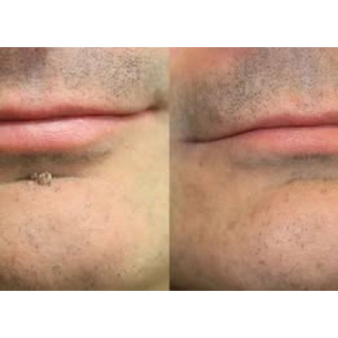 🌟XiMonth MICRONEEDLEBOTANIC SKIN TAG SOLUTION PATCH  InvisibleFace & Body Patches for RaisedMoles, Acne, Flat Warts & SkinTags -Helps Improve theAppearance of Wrinkles, Scars &Blemishes
