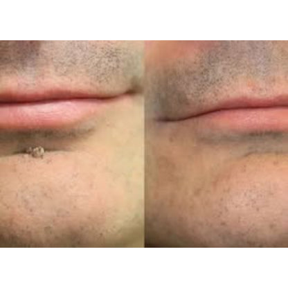 🌟XiMonth MICRONEEDLEBOTANIC SKIN TAG SOLUTION PATCH  InvisibleFace & Body Patches for RaisedMoles, Acne, Flat Warts & SkinTags -Helps Improve theAppearance of Wrinkles, Scars &Blemishes